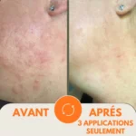 Routine Dermatites | Eczéma - 5