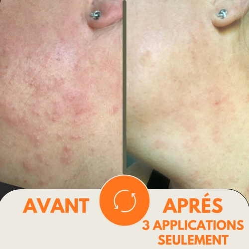 Routine Dermatites | Eczéma